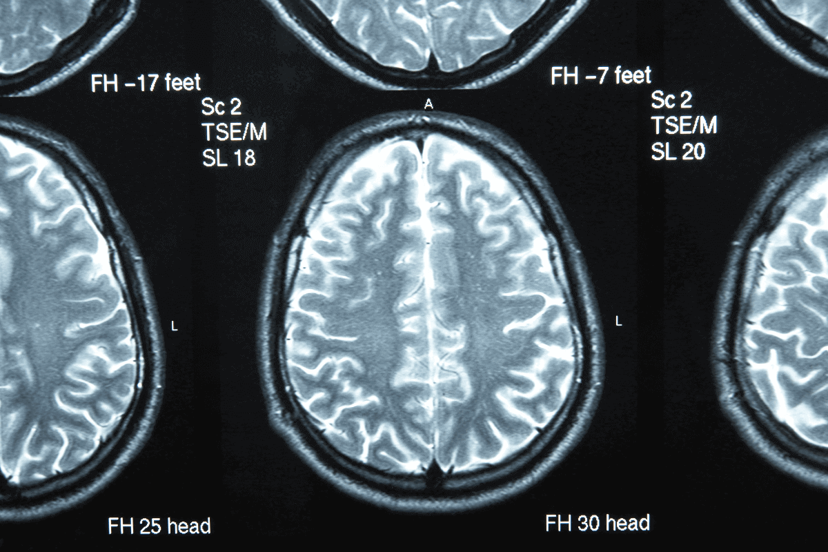 Image scan of a brain. Doctors use brain scanners to check for brain health.