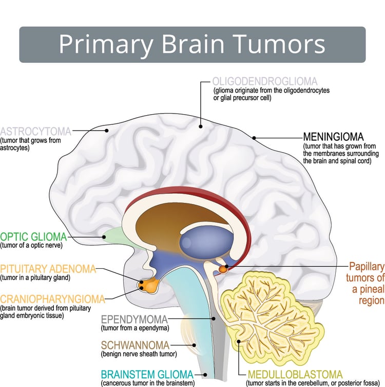 Types of Primary Brain Tumors